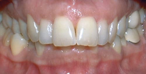 Overbite Problem Coastal Smiles Family Orthodontics in Naples, FL